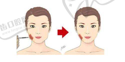 西安艺星润百颜黑金1mL|10份9999元起 Re-Bone骨相还原自然好评如潮