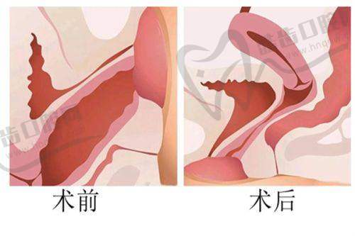 填充珊瑚骨和注射人工骨的其他方面区别