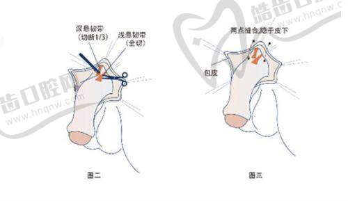 李继森：沈阳元辰整形“自然款双眼皮”天花板，为什么能让顾客说“像天生的”？