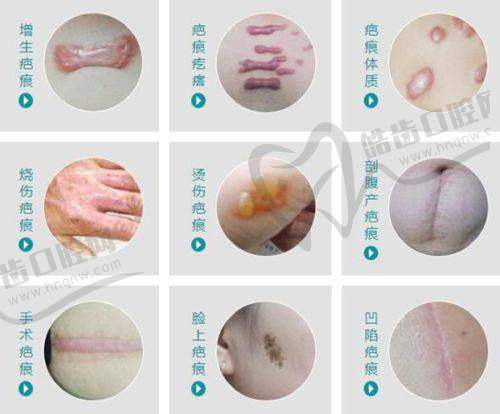 雷诺瓦用了6次停了会怎么样：正确停药方法
