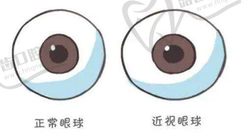 武汉佰视佳眼科美国Euclid OK镜8800元起,青少年近视防控神器