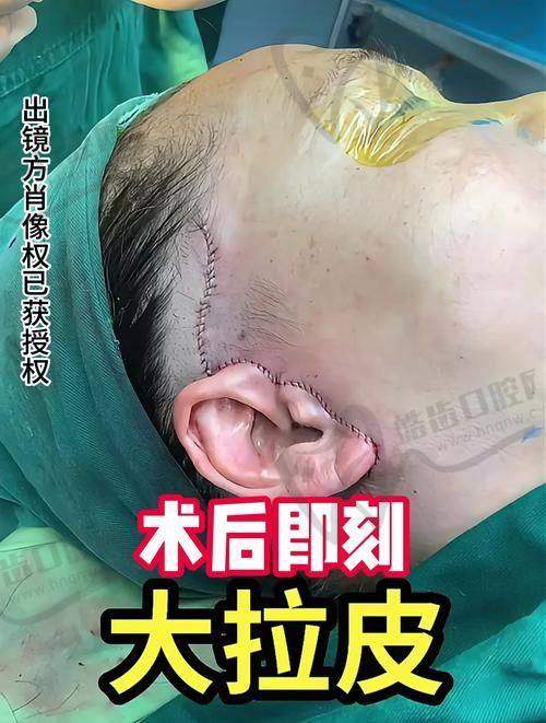北京联合丽格第二医院袁强博士是真的吗？拉皮手术优势与口碑大起底