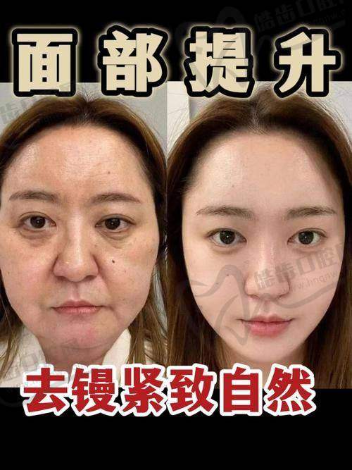 真实用户反馈揭秘袁强拉皮手术口碑为何评分这么高？