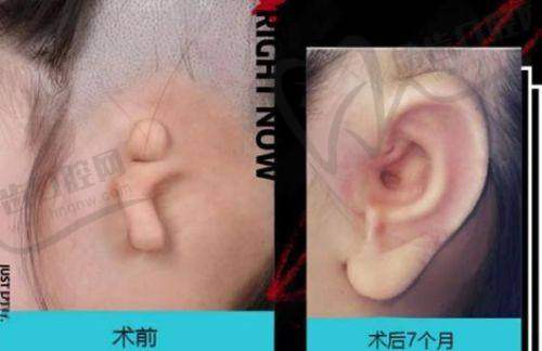 上海华美整形医院与弗缦胶原蛋白项目相关其他类型的收费价格参考