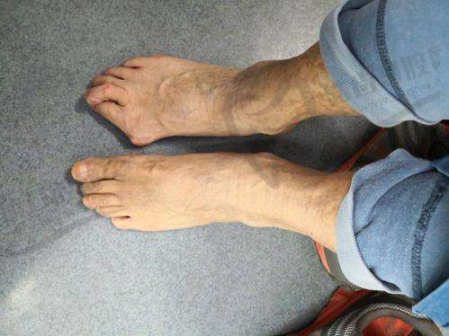 丁丁注射玻尿酸多少钱:剂量不同价格不同