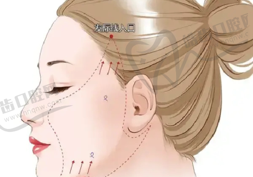 上海华美Fotona4D眼周7600元起 田波医生定制改善黑眼圈眼袋细纹方案