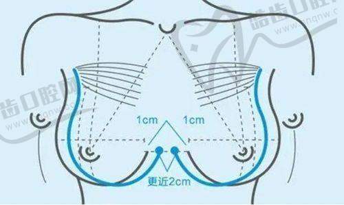 丁丁打玻尿酸医生建议的适合人群