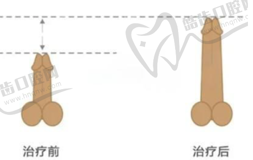 經(jīng)驗(yàn)多醫(yī)生做男性注射玻尿酸（HA）增大治療價(jià)格分析