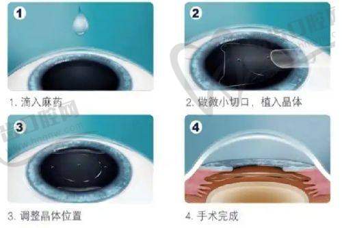 齐越医生眼底病治疗费用及方案