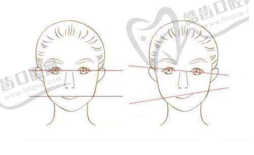 上海華美整形醫(yī)院M唇手術(shù)真人實例二