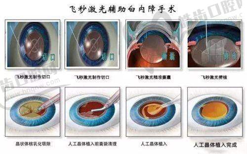 做男性私处玻尿酸，医生技术对价格的影响