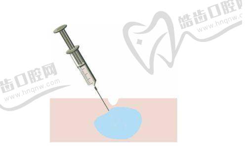 玻尿酸男性增大注射价格受注射剂量影响