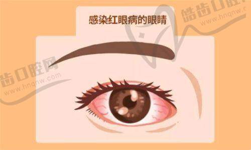 齐越医生视网膜后徙术费用及注意事项