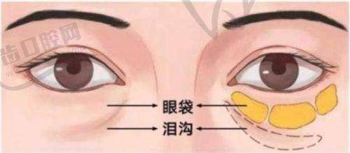 无痕筋膜提升和线提升的成效维持时间对比