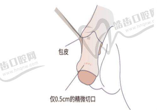 生物补片增粗手术医生应对后遗症的方法