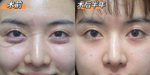 超脂塑体雕术去富贵包的适用人群