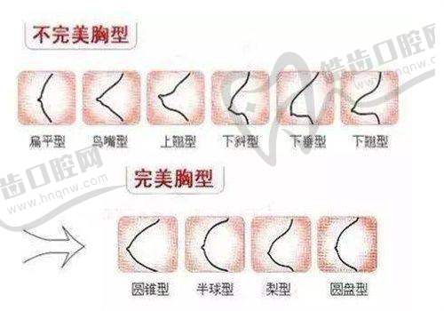 男科假体植入的舒适度体验