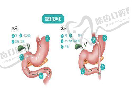 丁丁假体植入术视频：适用人群与禁忌情况