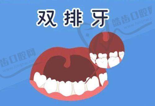南京烤瓷牙多少钱一颗价格表2025：不同医院的烤瓷牙价格