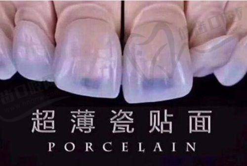 做牙贴面价格一般多少——美加牙齿贴面价格情况