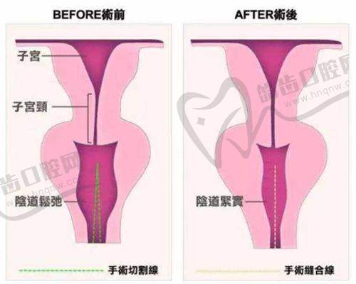 南京吸脂减肥的费用：康美医院价格情况