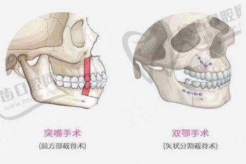 男科假体植入会不会不舒服：医生专精操作影响