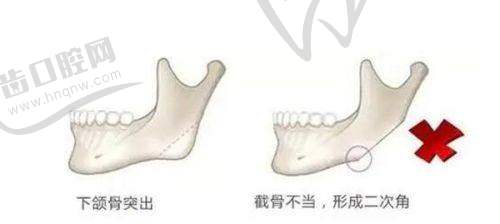 沈阳友谊美容医院生物补片增粗手术成果