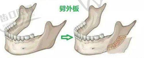 深圳博爱医院鼻部整形项目价格