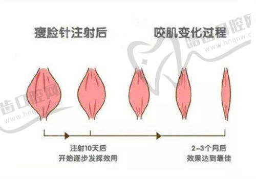 上海艺星医院打瘦脸价格多少？低至千元享专业技术，多品牌药剂安全塑颜 