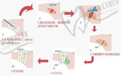 无痕筋膜提升和线提升的价格对比