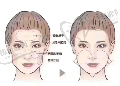 男科假体植入频繁操作的影响