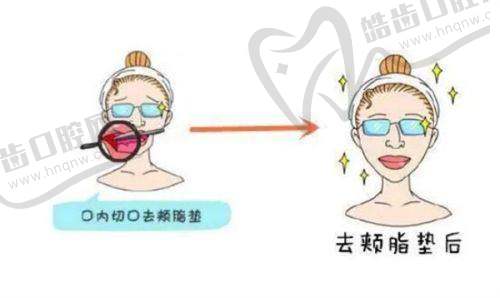 男科假体植入的费用情况