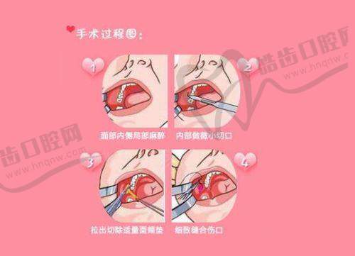 优质医院提升男科假体植入成功几率