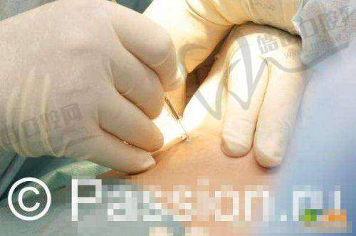 武汉汪灏医生隆胸预约电话在这里,特色隆胸技术,术后效果宛如天生