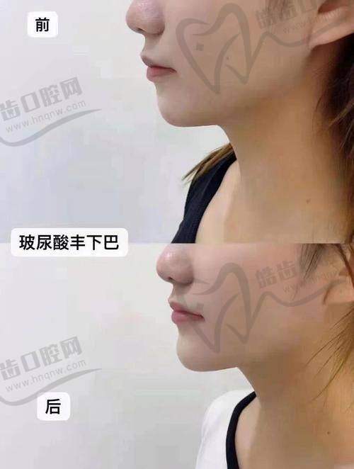 婕爾玻尿酸有哪些優(yōu)勢？是否存在使用風(fēng)險(xiǎn)？