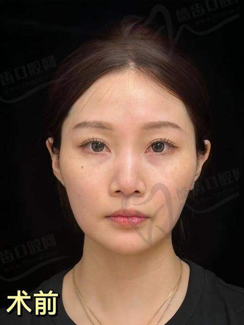 瑞藍定采和喬雅登豐顏的區(qū)別在用戶體驗與舒適度：疼痛與腫脹反應不同