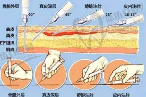 腋臭做手术可以完全有效治疗吗？手术复发因素探讨