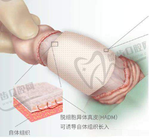 腋臭手術(shù)后會(huì)復(fù)發(fā)嗎？洛陽(yáng)華美整形醫(yī)院的技術(shù)與復(fù)發(fā)情況