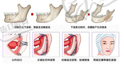腋臭的手术一般多少钱——激光治疗价格及成效