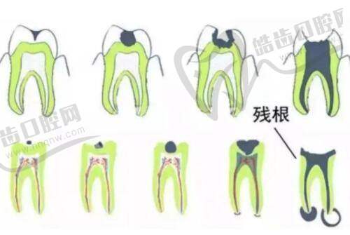 進口三件套使用壽命多久之與國產(chǎn)對比