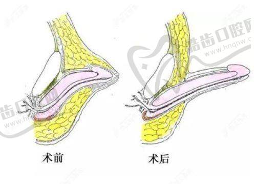 国产三件套使用寿命多久：故障率相关探讨