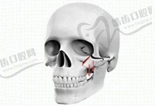七、脸上打轻薄是不是溶脂针——适用人群与禁忌对比