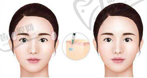 三、轻薄针能消除馒化脸吗：临床成效与实例参考