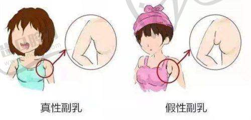 上眼睑下垂怎么改善：常见的改善方法