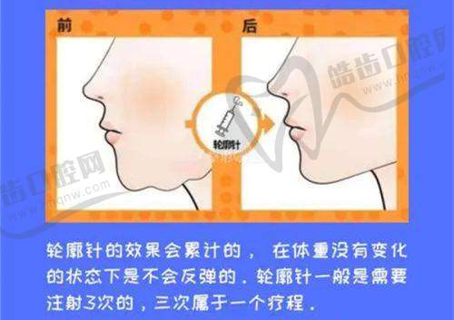 进口三件套假体大概多少钱?——张国喜手术价格情况
