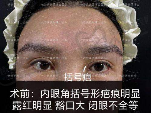 尹海荣医生的眼部整形失败修复优势