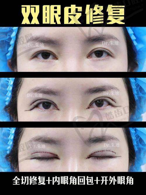 适合做周美兰医生修复双眼皮的人群盘点