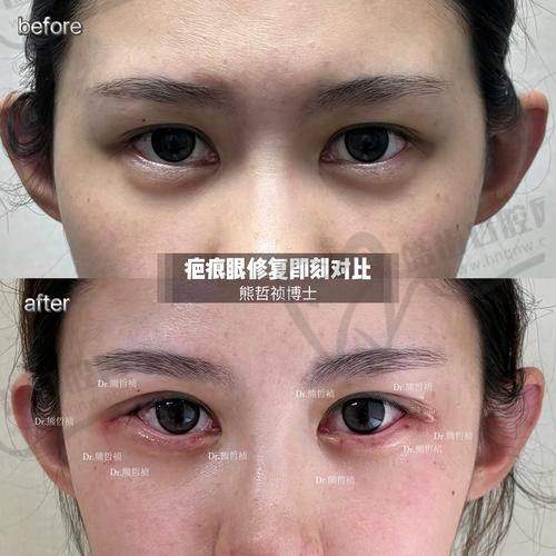 术中细节决定术后差异：分层缝合 VS 传统缝合对比