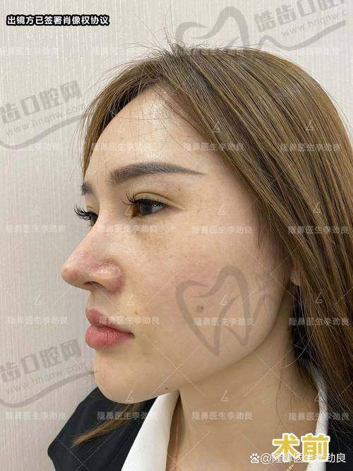 术后反馈与社区口碑：自然风术后满意度高，不容易撞脸