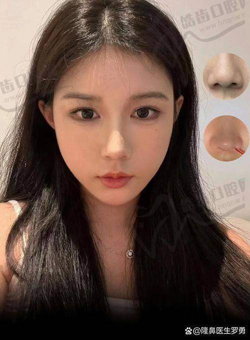 特别提醒：关于术后修复期和注意事项